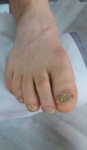 unghiile de la picioare se desprind, dar nu fungi tratamentul ciupercilor degetelor de la picioare și unghiilor de la picioare